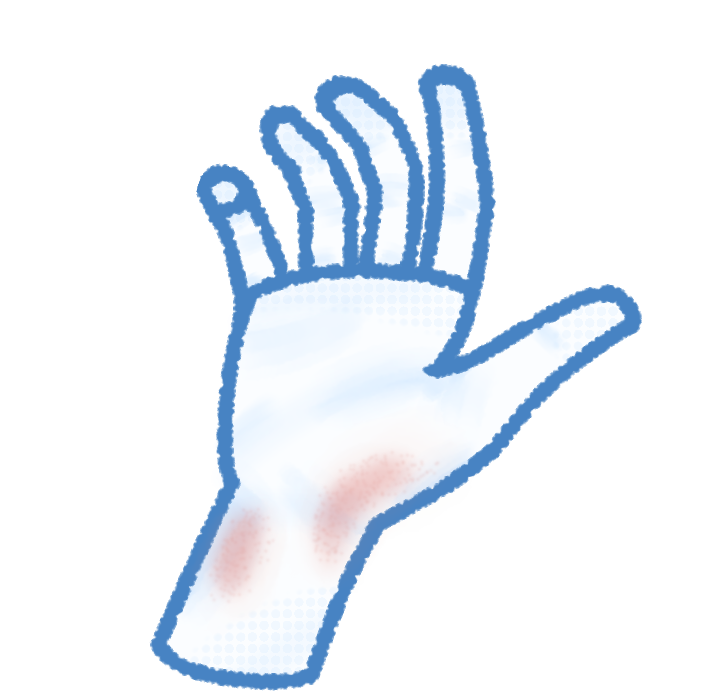 A white and blue toned drawing of a hand and wrist with friction burn scars on the wrist.